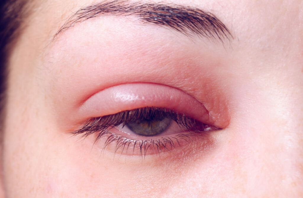 A close-up of an eye with swollen eyelids.