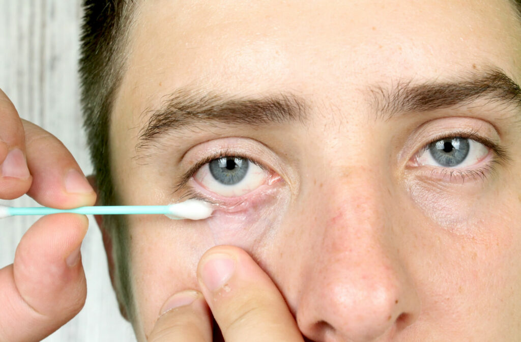 A close-up of a man doing a home remedy to clean the blockage on his eyelids at home by using a cotton swab  TearCare & LipiFlow is a great option to treat MGD.