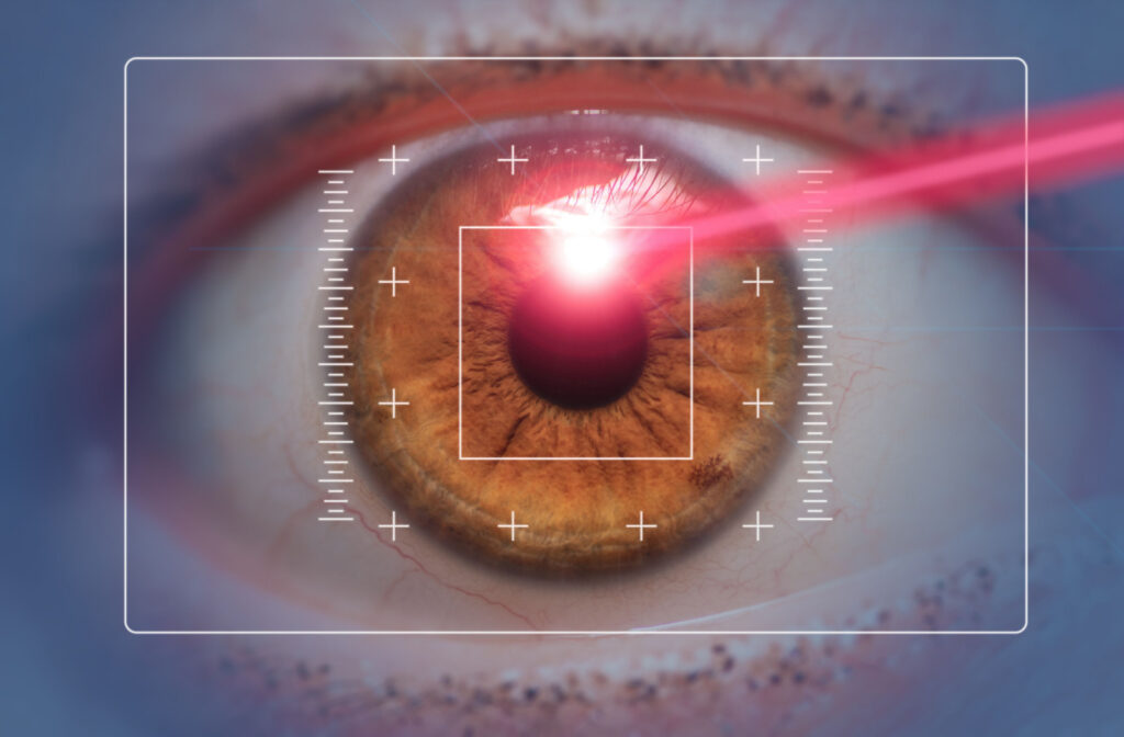 A close up of a brown eye with a red laser going to the center to display the idea of SMILE laser eye surgery.